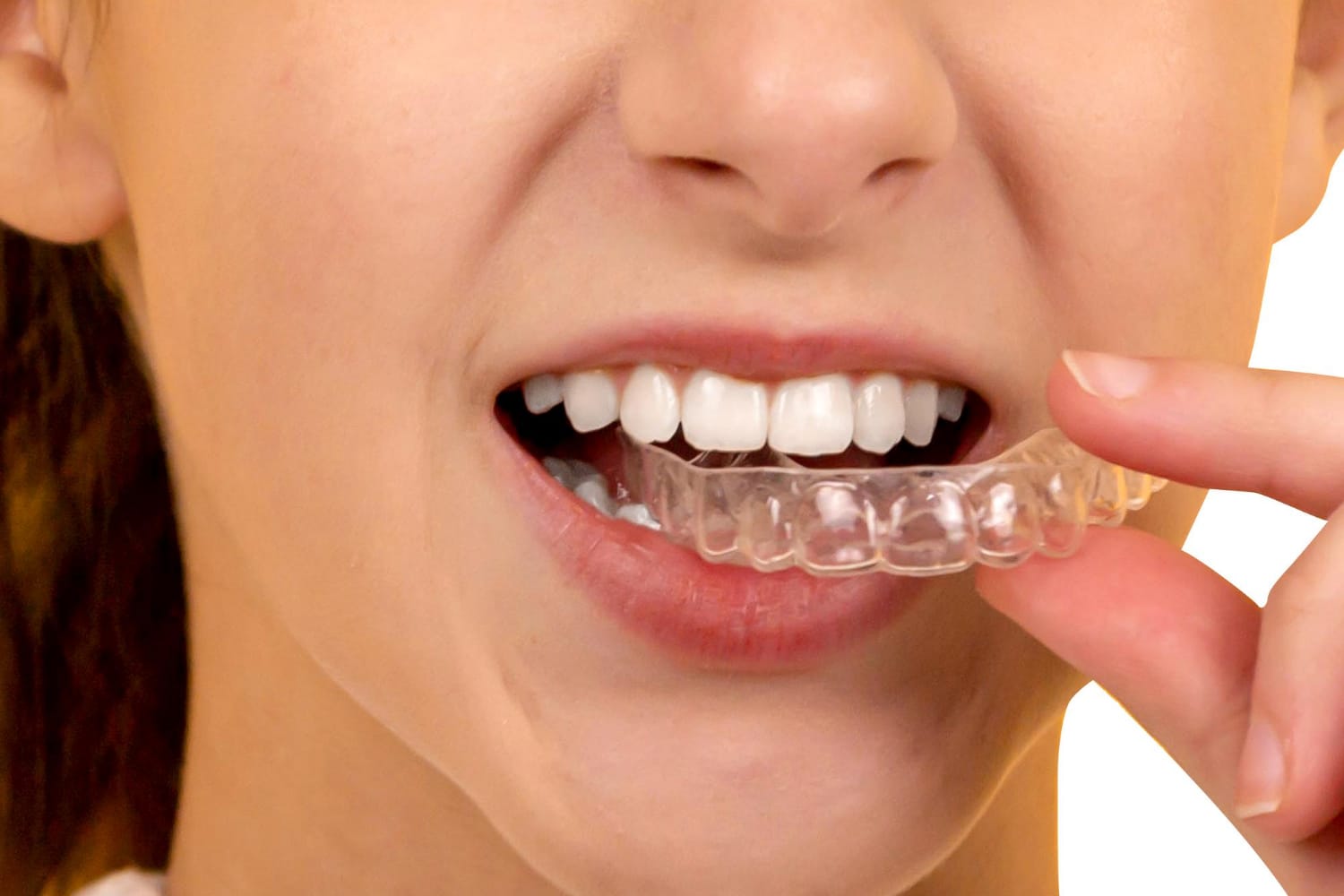 Элайнеры Star Smile